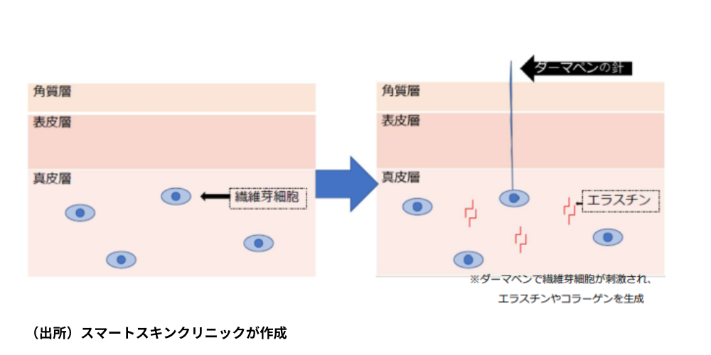 Dermapen Mechanism of Action