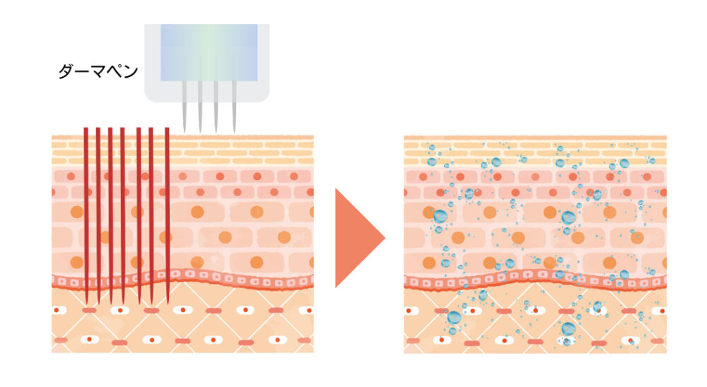 Diagram explaining how the dermapen works