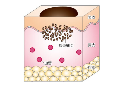 Pathogenesis of pigmented nevi (moles)