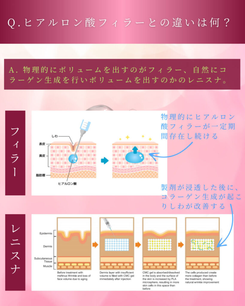 Difference between hyaluronic acid and renisna