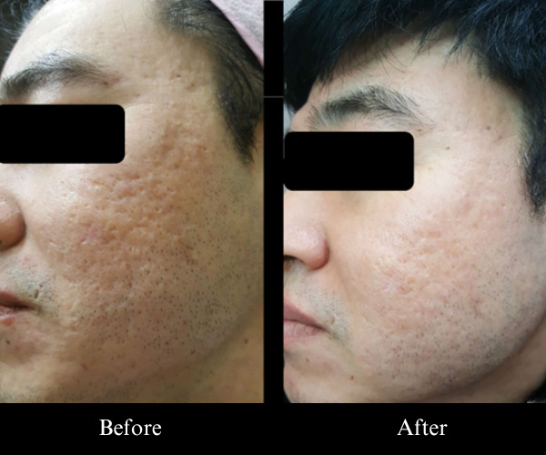 Acne scar (crater) Jubeluk case (3)